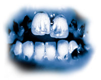 Τα τοξικά συστατικά της μεθαμφεταμίνης προκαλούν σοβαρά προβλήματα τερηδονισμού των δοντιών, γνωστό και ως «στόμα της μεθ». Τα δόντια μαυρίζουν, γεμίζουν λεκέδες και σαπίζουν μέχρι το σημείο που πρέπει να βγουν. Δόντια και ούλα καταστρέφονται από μέσα και οι ρίζες σαπίζουν.